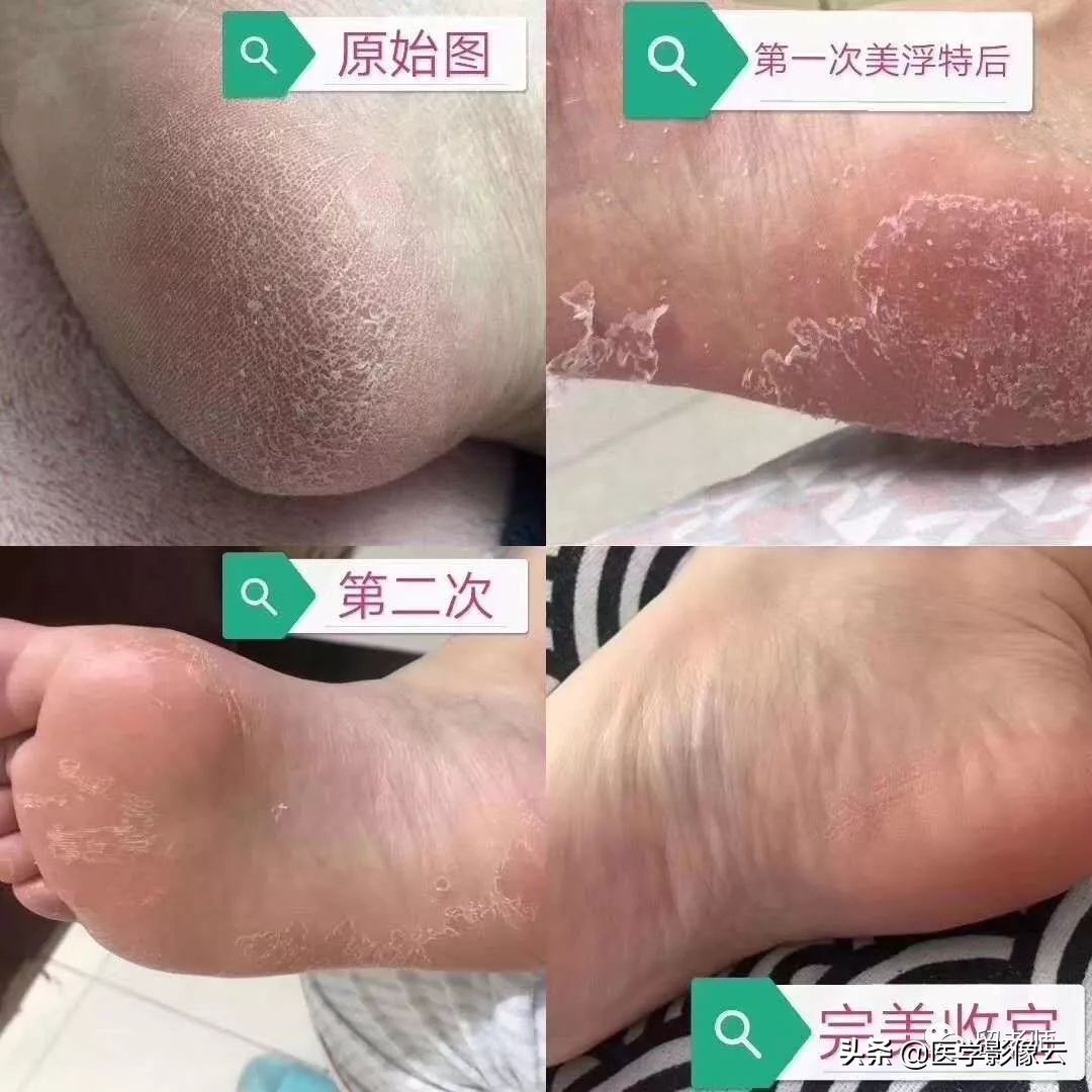 足部扁平苔藓,足癣病例