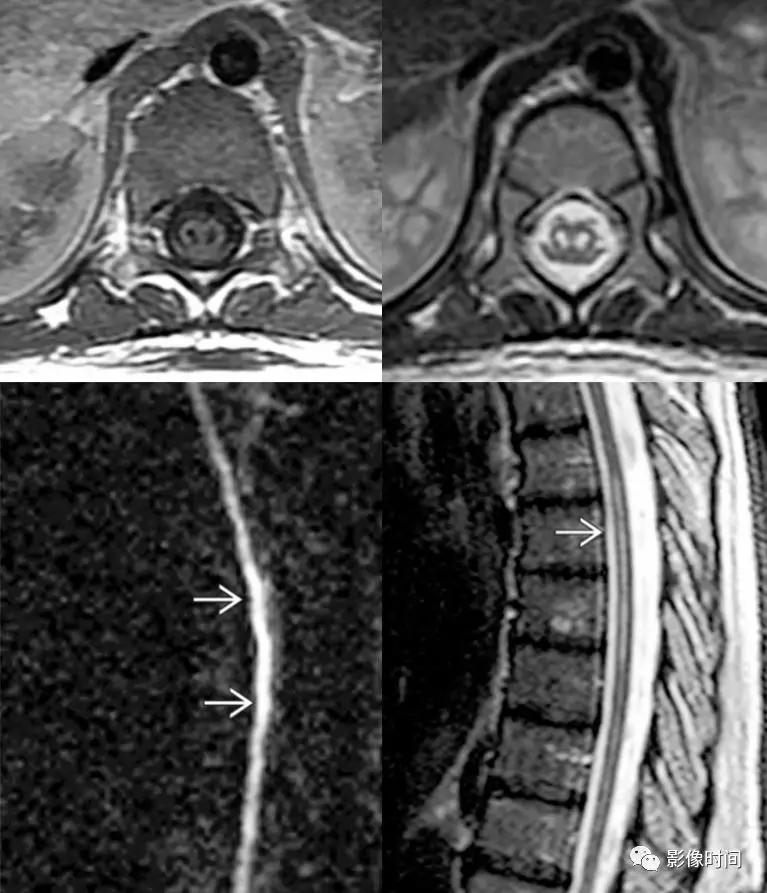 脊髓病变案例图文问诊,脊髓病变视频