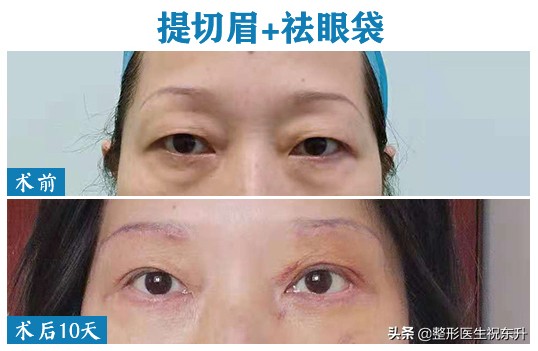 妈妈想做眉毛,妈妈急需做手术