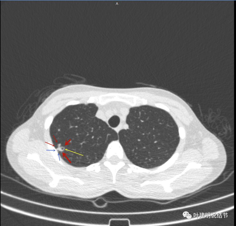 临床诊断孤立性肺结节,空洞型结节一般是什么性质