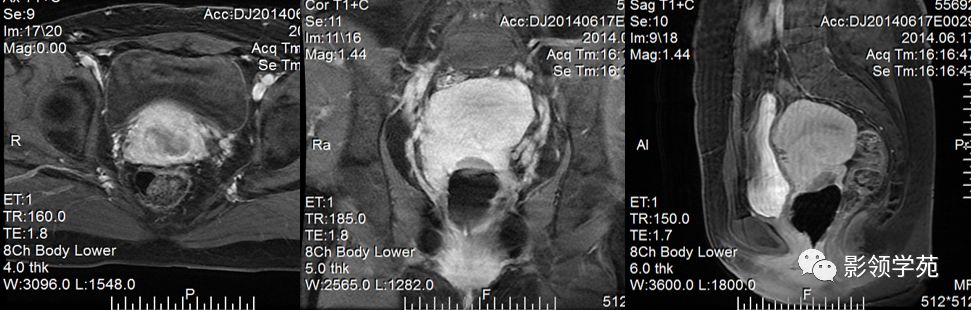 宫颈癌mri诊断,宫颈癌的mr扫描技术