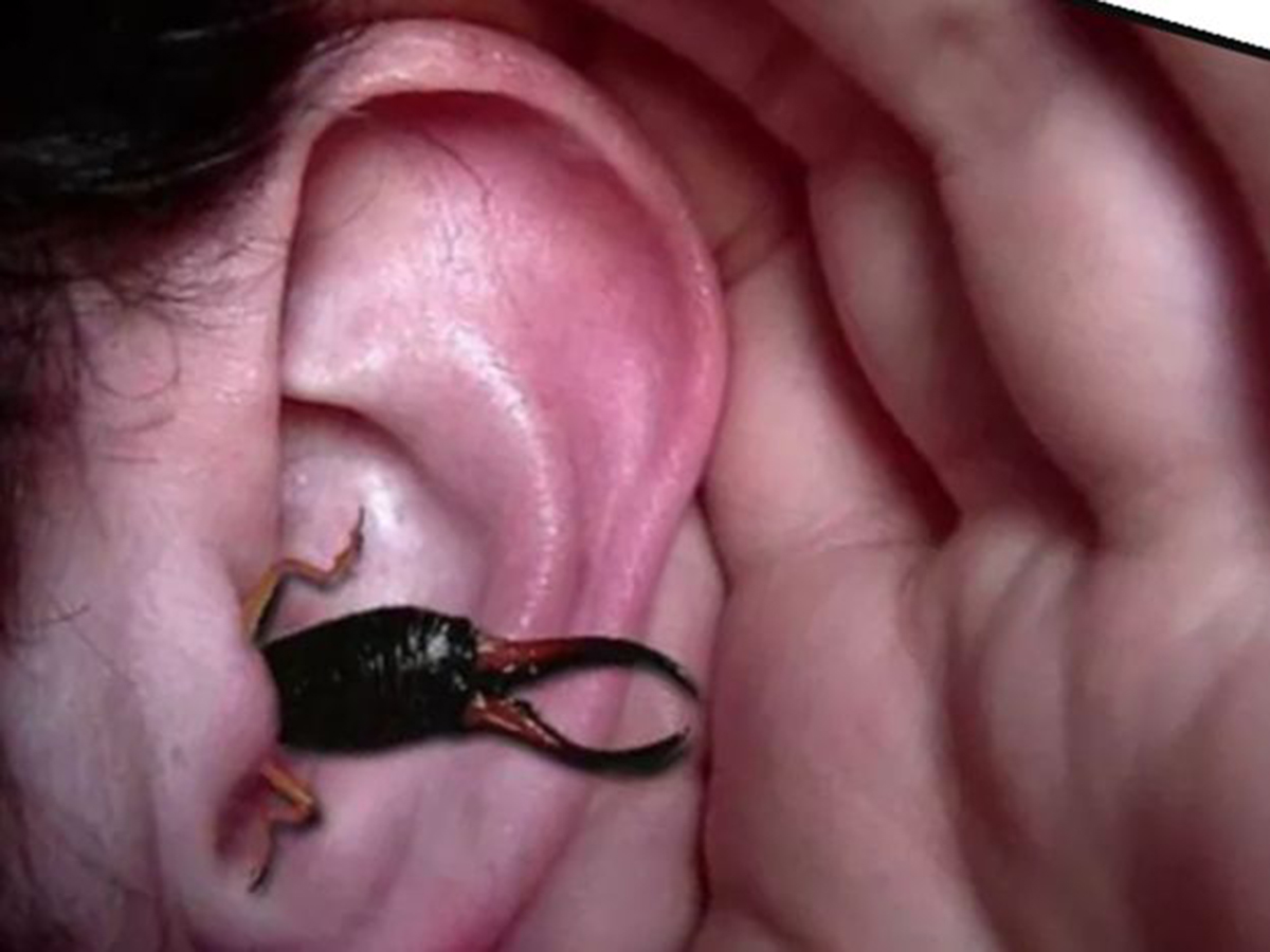 尾部长钳子的耳夹子虫,尾部带夹子的虫子