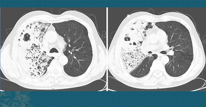 克雷伯氏肺炎菌,糖尿病人容易感染克雷伯菌吗