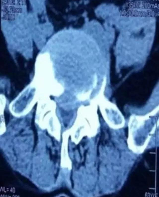 王学昌谈腰椎管狭窄,王学昌治疗神经根型颈椎病视频