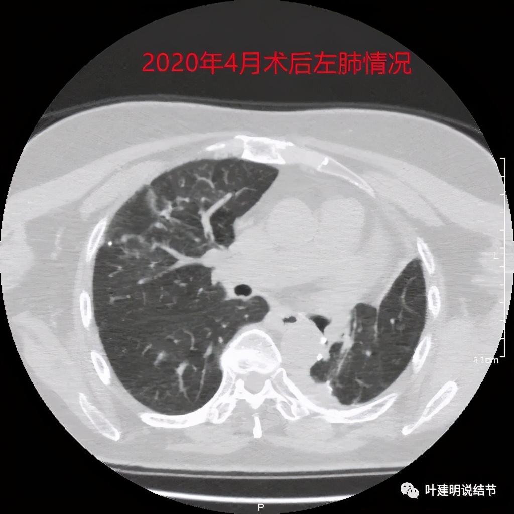 左肺癌手术半年右肺下角还有炎症,左下肺癌晚期