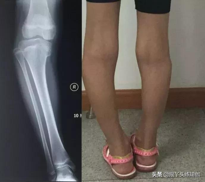 o型腿不好看怎么矫正,既能改善o型腿又能瘦腿的方法