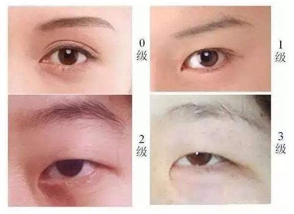 眼睛太圆了怎么修复双眼皮,眼睛已经是双眼皮太小了怎么变大