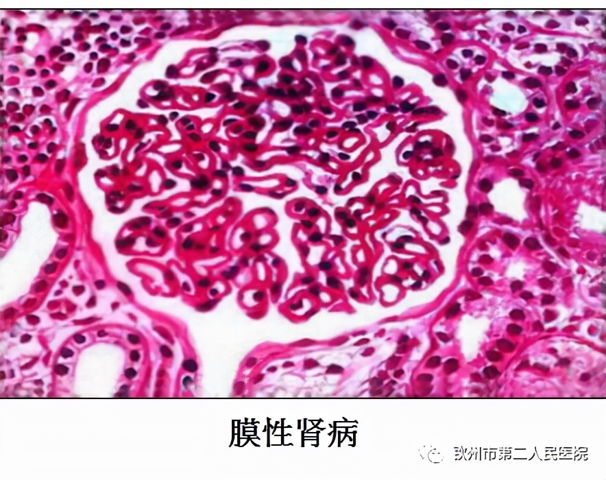 什么是肾穿刺,什么是肾穿刺检查