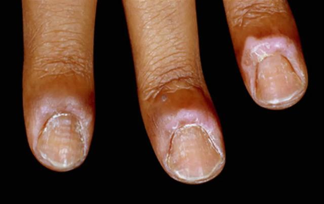 解决甲沟炎比较好的方法,甲沟炎很严重怎么修