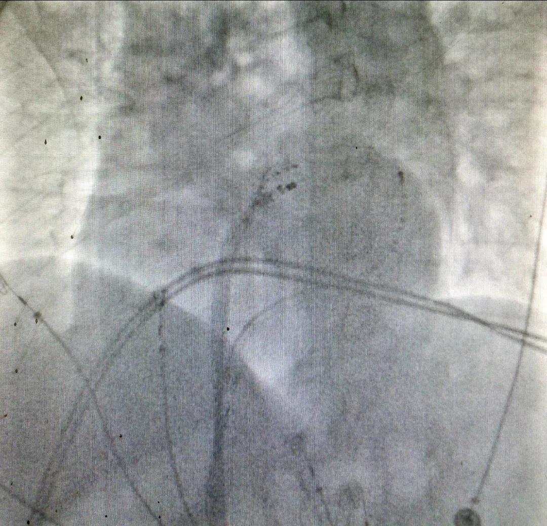 邵武市立医院心内科,中心医院房颤消融手术好吗