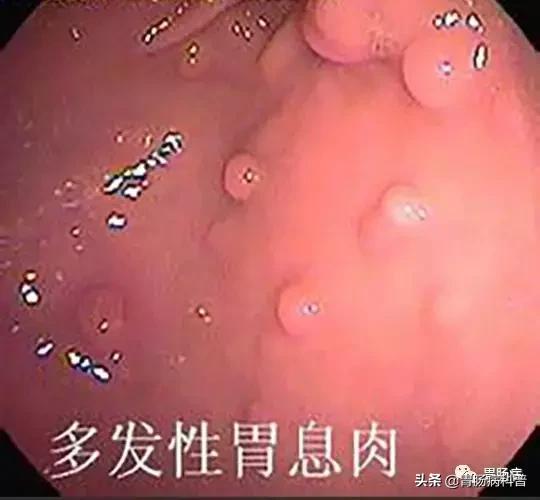 胃增生性肠息肉严重吗,胃体增生性的息肉是什么意思