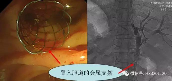 ercp胆道支架植入,ercp胆道支架植入术青大附院