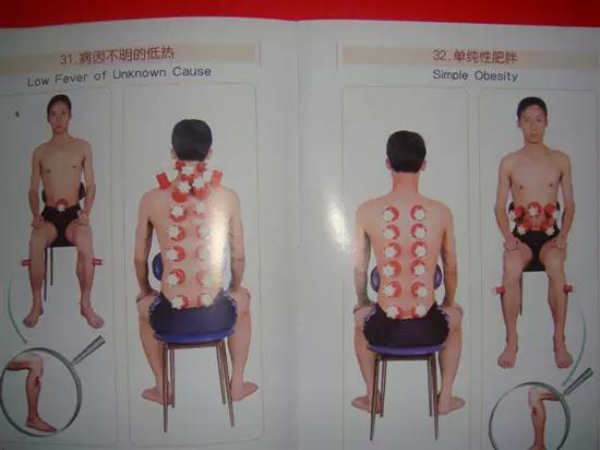 拔罐有哪些穴位图解,最全拔罐穴位疗法图解