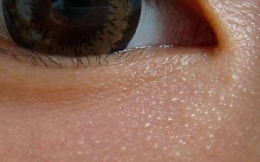 眼皮下面长了个小疙瘩,眉毛下面眼皮上长满小疙瘩