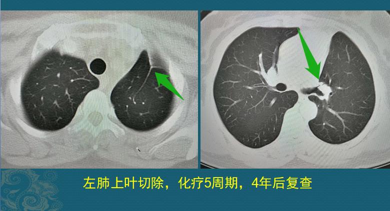 肺癌侵犯胸膜胸腔积液内有癌细胞,中心型肺癌侵犯胸膜疼痛怎么办