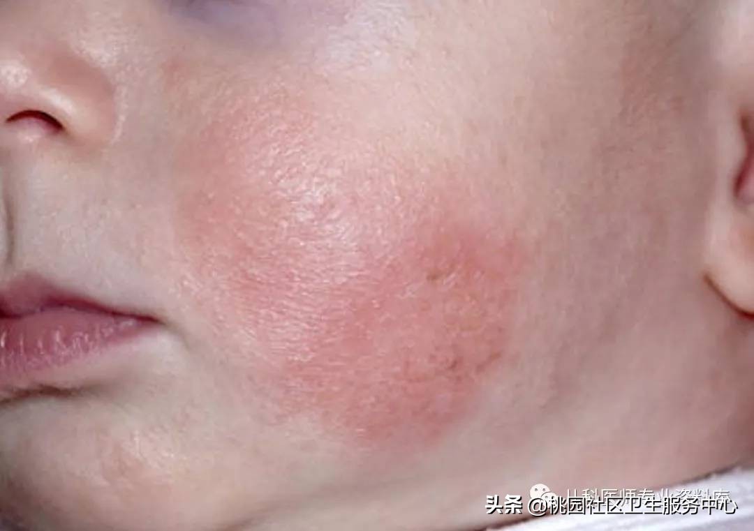儿童湿疹和痱子要分清楚,成人痱子和湿疹如何分别