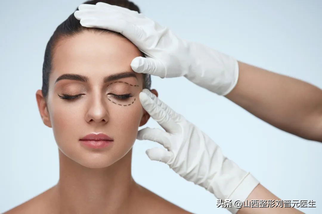 埋线抽脂双眼皮二十天了还不自然,8.5毫米的埋线双眼皮自然吗