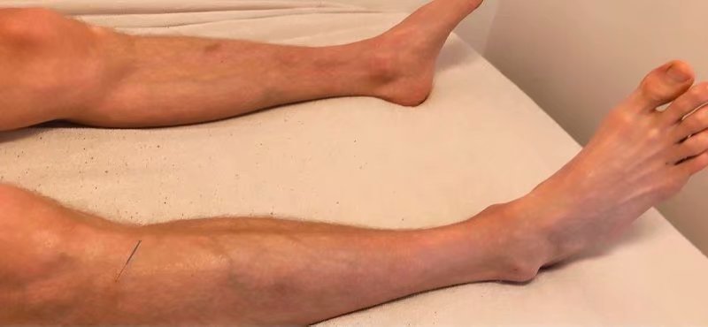 大循环治膀胱经从屁股到膝盖窝麻痛与久咳