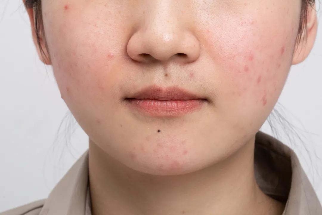 每到换季就会爆痘,换季时爆痘