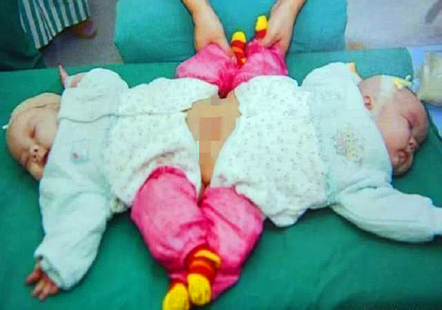 还记得当年的双胞胎么,双胞胎坐骨连体成功分离11年