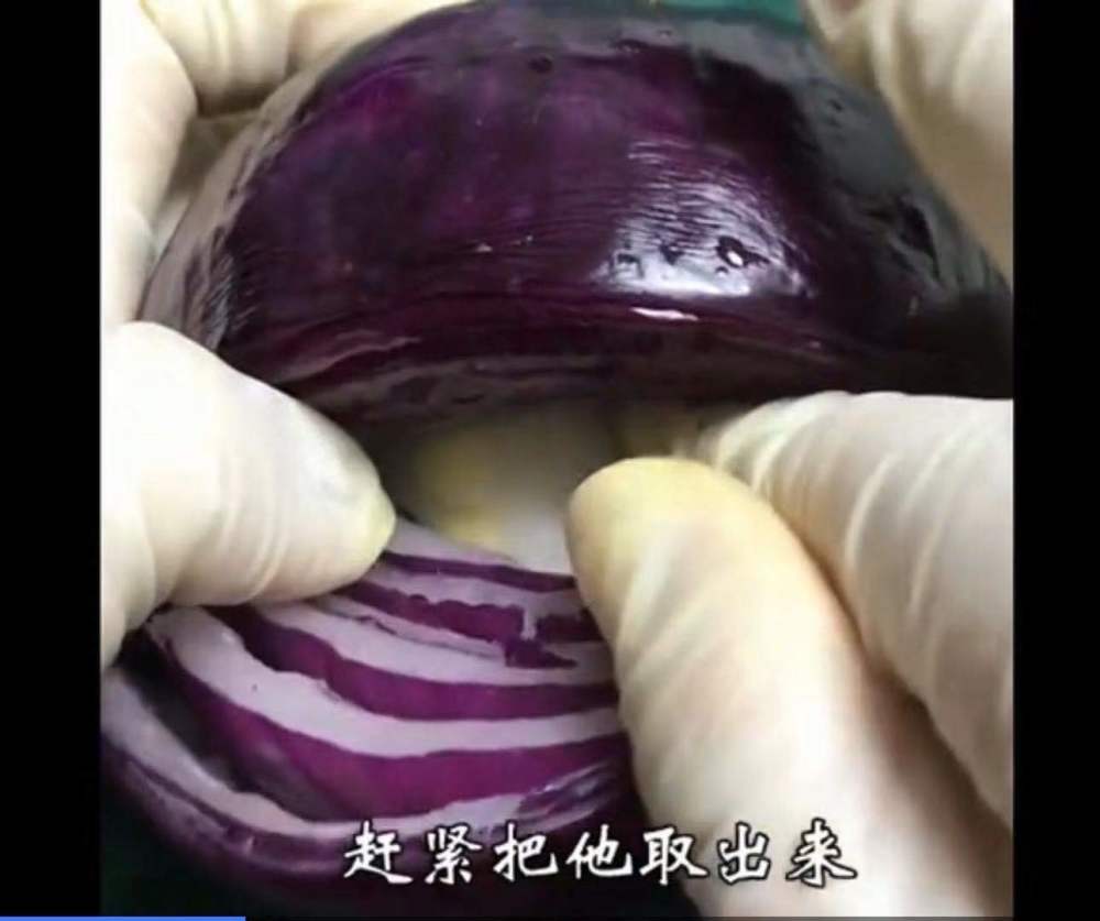 剖腹产的手术全部流程,洋葱模拟剖腹产手术