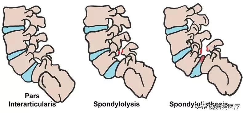 腰痛是不是因为驼背,腰两侧椎弓崩裂什么引起的