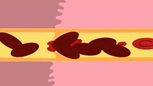 血管堵没堵？弯腰摸这里！一个小动作，冲刷干净夺命血栓