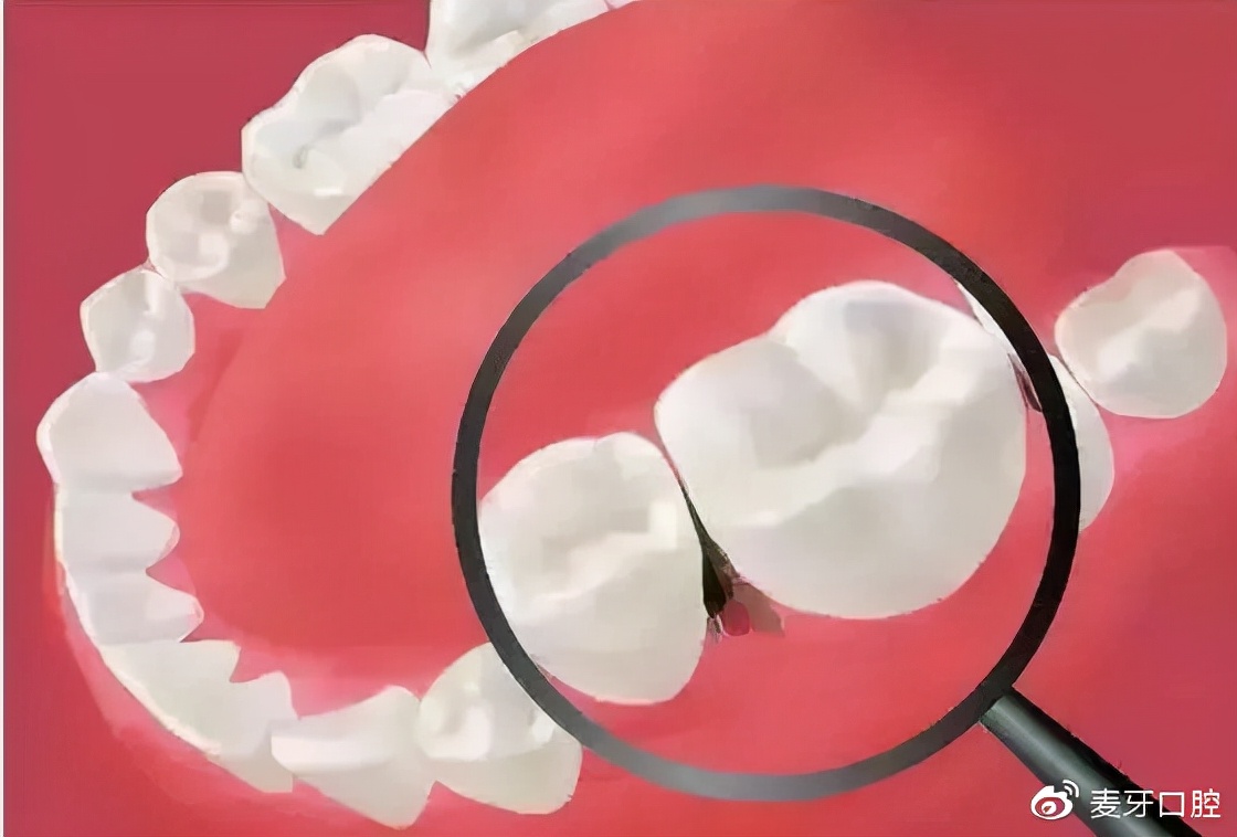 吃肉塞牙牙缝臭怎么办,总是塞牙牙缝臭