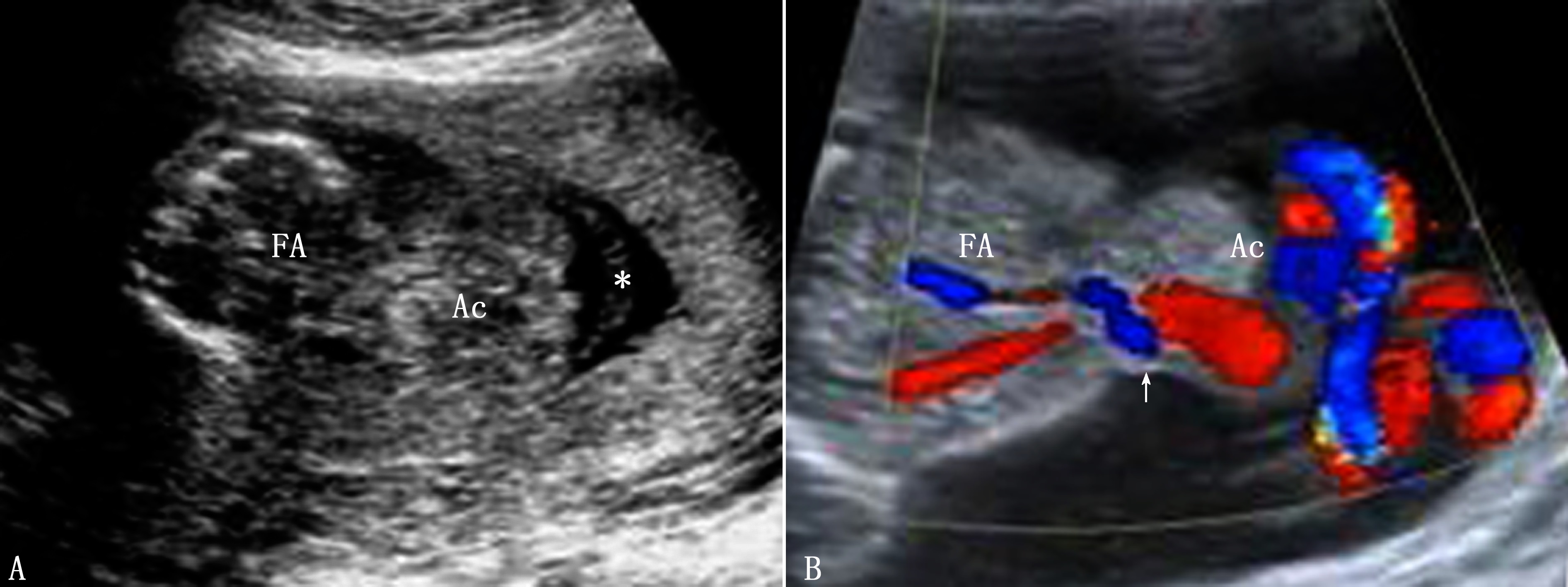 明明白白做超声28-12：前腹壁异常