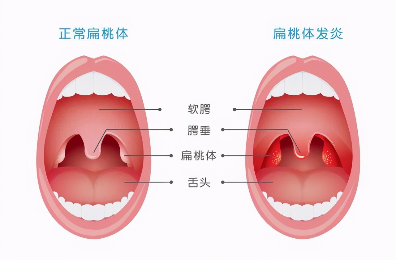 拔完智齿第三天就开始撸串了,智齿拔完一周可以撸铁吗