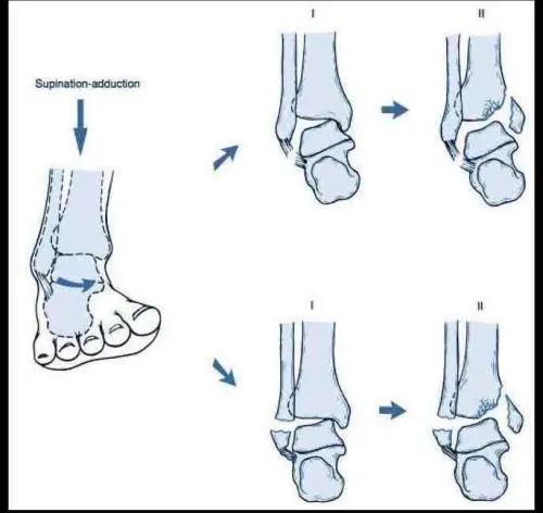 跑步跟腱炎最好的治疗方法,跟腱炎跑步不疼跳起来疼