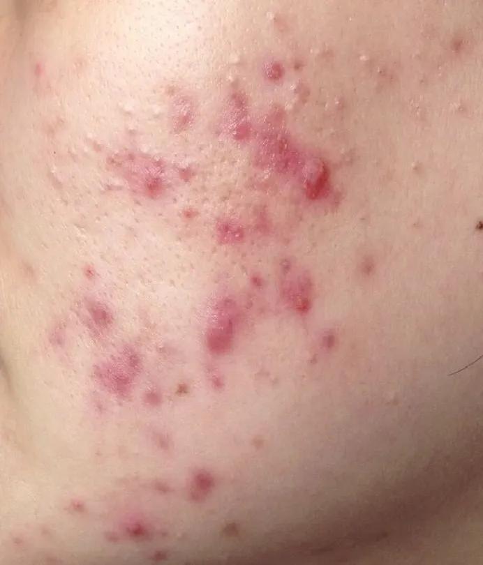 医学美容科治疗痘痘吗,激光祛痘适合哪种痘痘