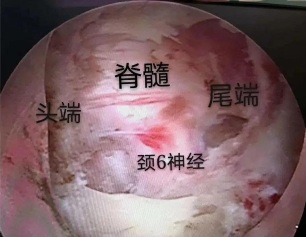 成功开展“钥匙孔”技术治疗颈椎病