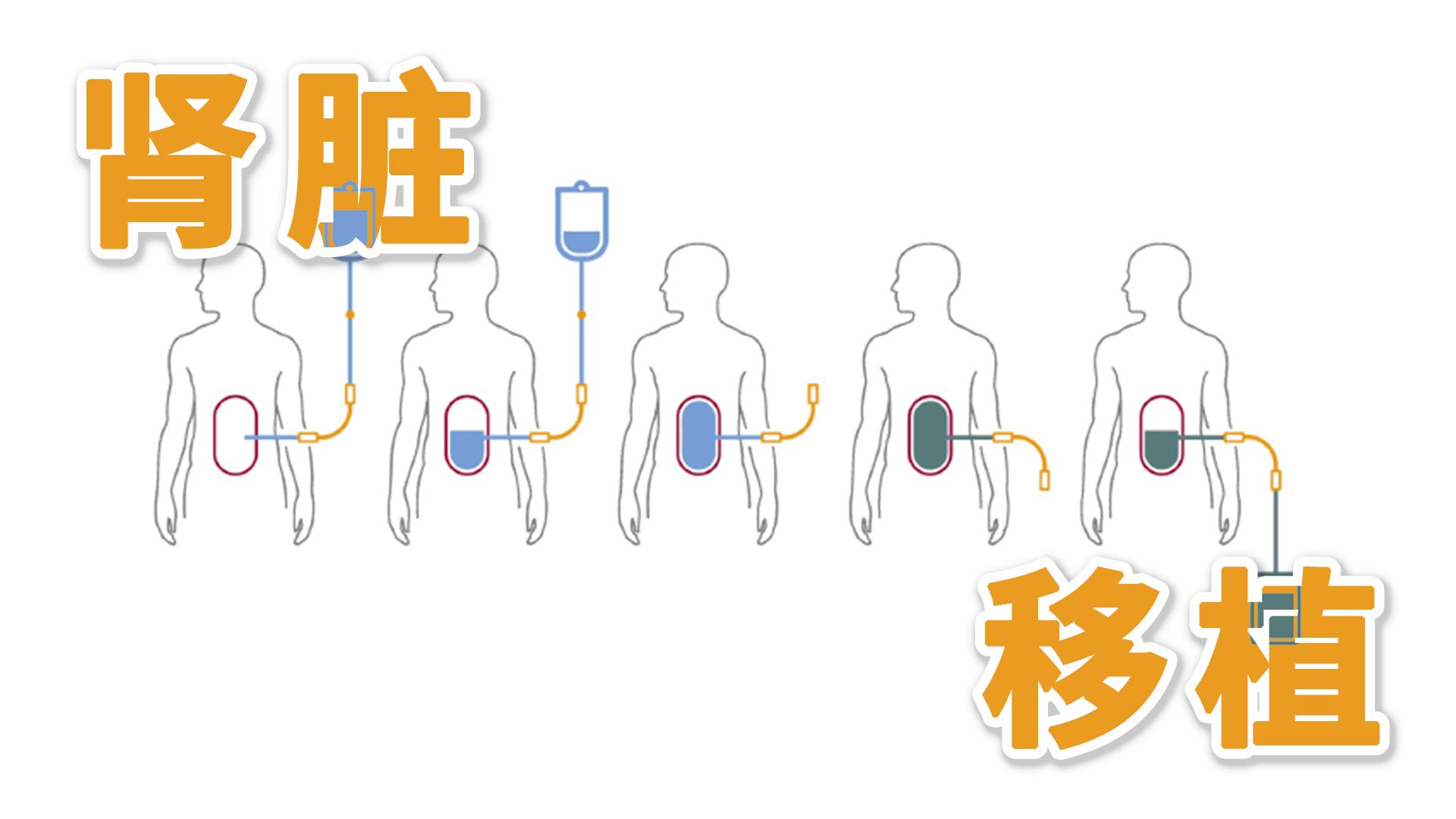 尿毒症的肾脏替代治疗方式,尿毒症替代治疗