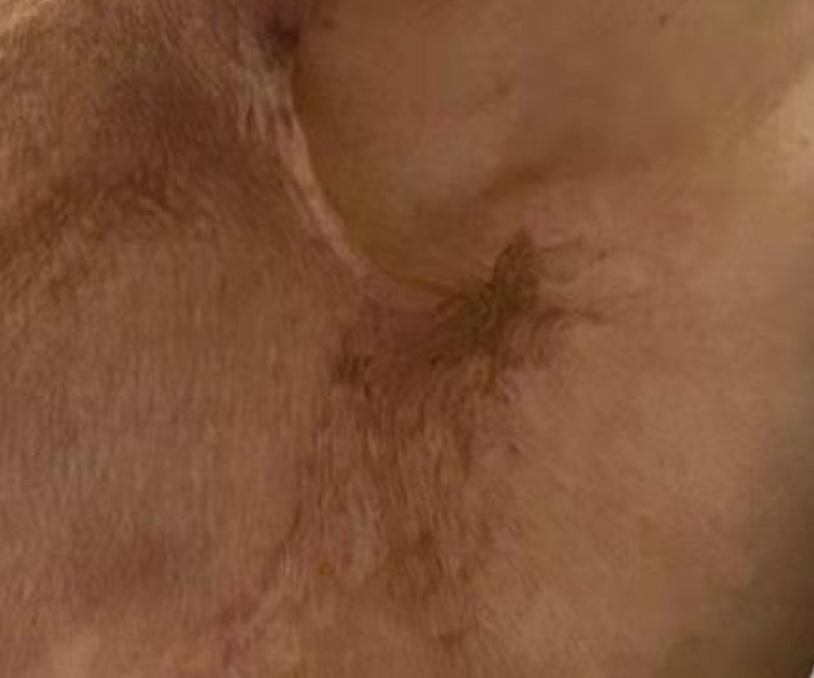 受伤后容易留疤是为什么,受伤后怎么处理能防止留疤