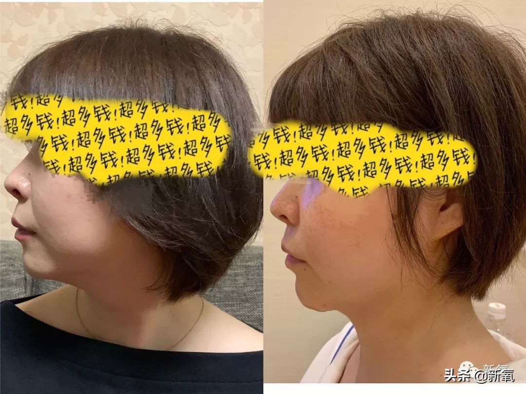 迷死氧亲身体验,我在日本吸掉了一桶脂肪和半张脸