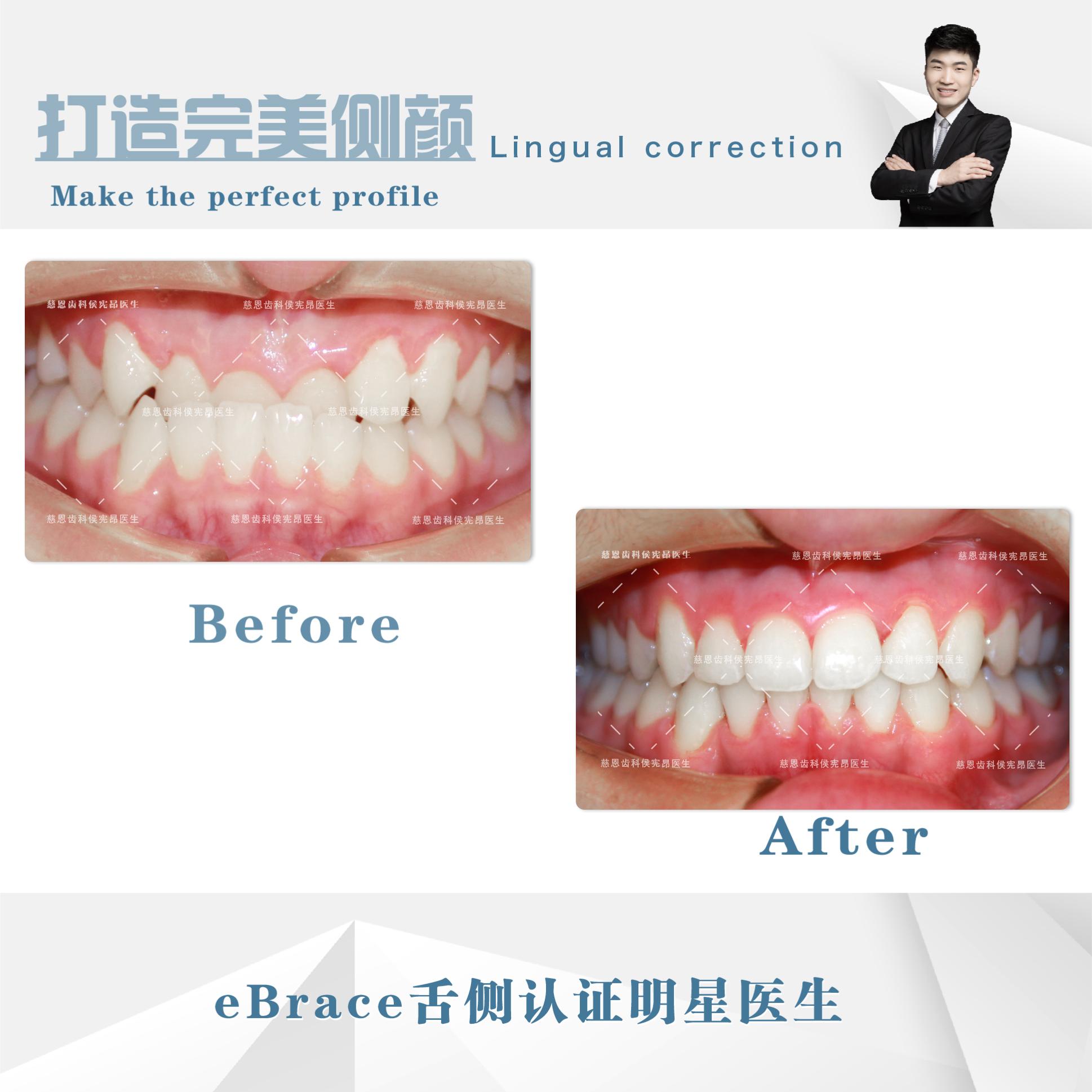 牙齿地包天矫正前后脸型对比,牙齿地包天矫正最低价多少钱
