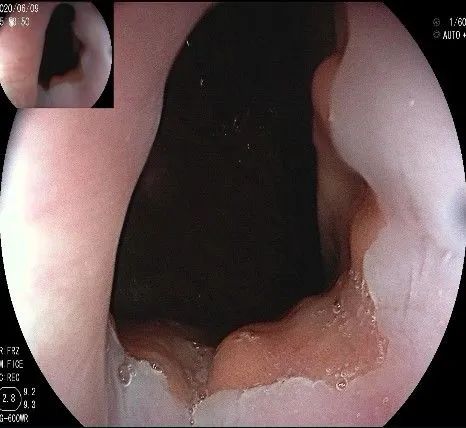 贲门处见隆起性病变,贲门高级别瘤变esd术后不能吃什么