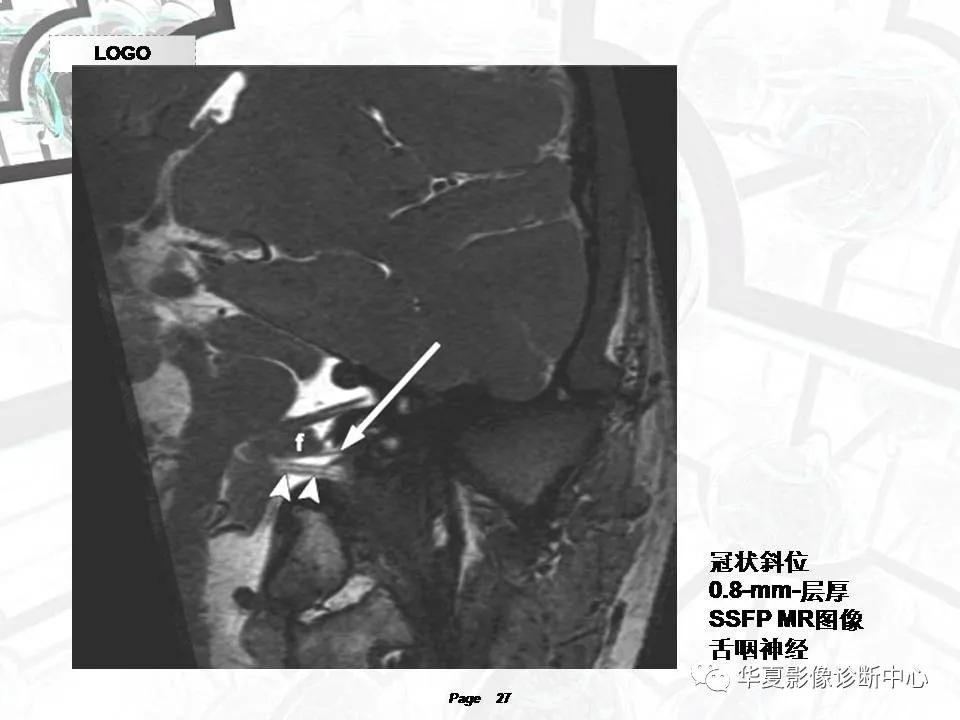 磁共振颅神经扫描是定位在哪,颅神经图谱