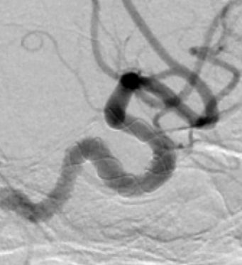 Tubridge®治疗多发性动脉瘤