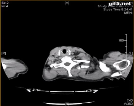 仓静教授最新视频,急性气道阻塞麻醉
