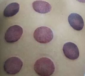 一看就会手把手教拔罐疗法,学拔罐视频教程全集