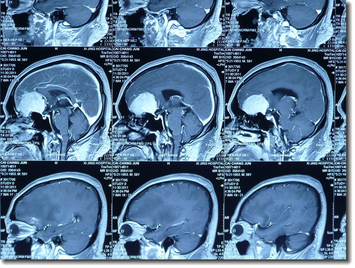 鞍结节脑膜瘤误诊为垂体瘤,鞍结节脑膜瘤发病原因