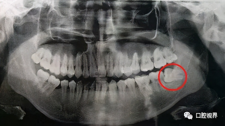 鑱婅亰鎷旂墮鐨勯偅浜涗簨鍎挎湳鍚庢仮澶嶇瘒,30骞存嫈鐗欏疄鎴樼粡楠屽垎浜嫈鐗欑柤涓嶇柤