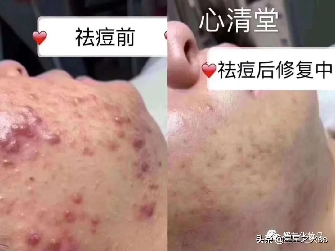 心清堂护肤品祛痘修复,兰树心清堂祛痘效果