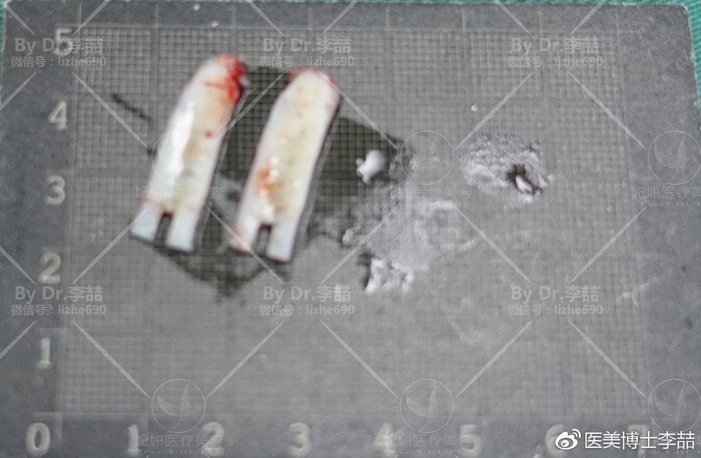 先天性鼻缺损和畸形的修复,先天性鼻中隔缺损