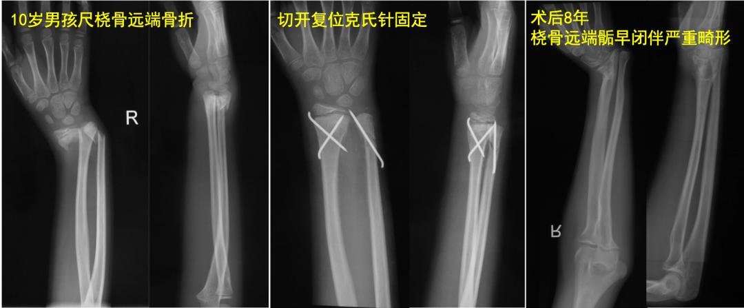 两个儿童前臂骨折争议病例之——元芳你怎么看
