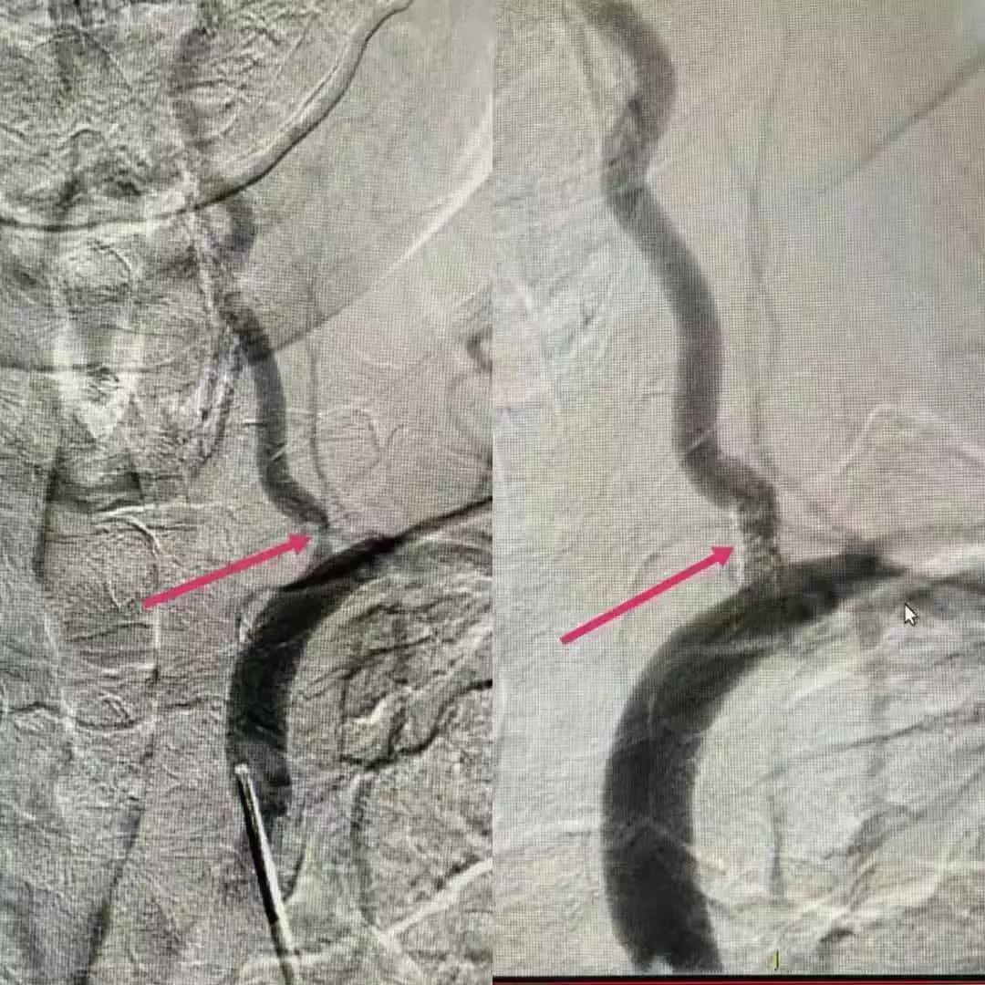 血管狭窄百分之五十吃药控制病情,血管狭窄有办法逆转吗视频