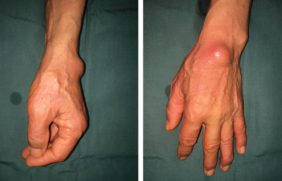 老汉长鸽子蛋大的结石,79岁老人左手腕长鸽子蛋