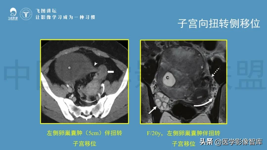 子宫解剖结构输卵管和卵巢位置,子宫附件ct影像学正常解剖表现